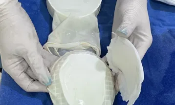 Tecnologia: HUOP realiza primeira cirurgia craniana com molde criado em impressora 3D