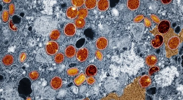Região Norte do Brasil registra casos de mpox