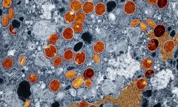 Região Norte do Brasil registra casos de mpox