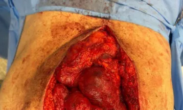 Bolsonaro publica imagem perturbadora de seu abdômen aberto e assusta internautas