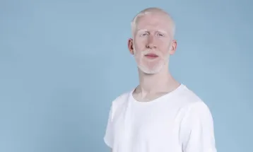 Sancionada lei que cria política de proteção a pessoas com albinismo