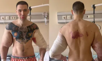 Influenciador "retira bíceps" após injetar substâncias para inchar músculo