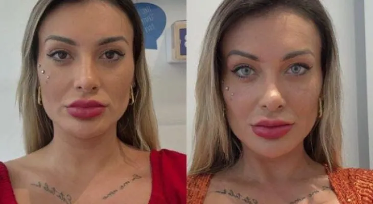 Andressa Urach relata fortes dores após mudar a cor dos olhos e se arrepende do procedimento