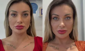 Andressa Urach relata fortes dores após mudar a cor dos olhos e se arrepende do procedimento