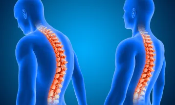 Dia da Prevenção à Escoliose, celebrado em 27 de junho, chama atenção para diagnóstico precoce e cuidados com a coluna