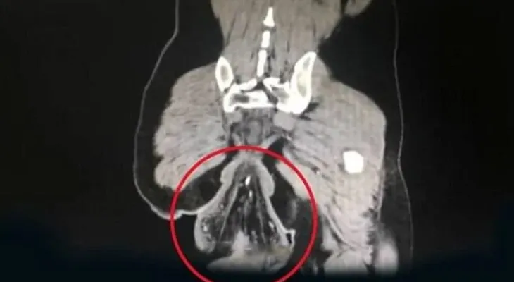 Ânus de homem cai após ele ficar na privada com celular por meia hora