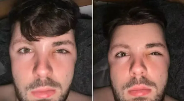 “Cabeça de balão”: homem incha após ignorar proibição de sexo depois de transplante capilar