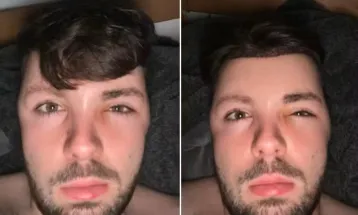 “Cabeça de balão”: homem incha após ignorar proibição de sexo depois de transplante capilar