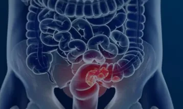 Estudo projeta aumento de 36% em mortes por câncer colorretal até 2040