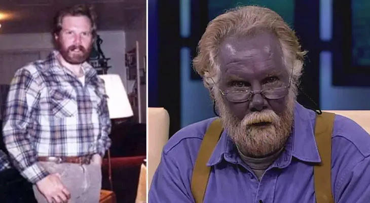 Homem fica com a pele azul após automedicação com prata coloidal