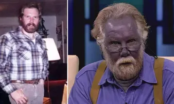 Homem fica com a pele azul após automedicação com prata coloidal