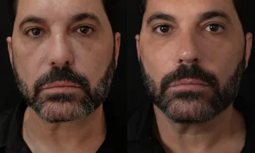 Edson, da dupla com Hudson, investe R$ 35 mil em procedimento estético em SP