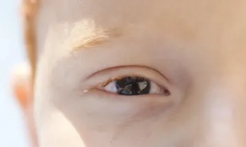 Erros de refração são principal causa de deficiência visual infantil