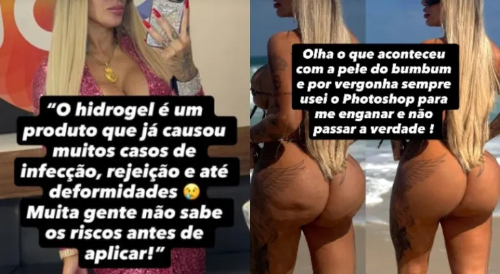 Influenciadora Juju Ferrari passa por cirurgia de emergência para retirada de hidrogel no bumbum
