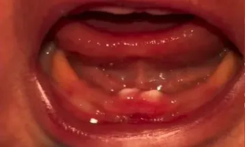 Bebê nasce com dois dentes e passa por cirurgia para remoção