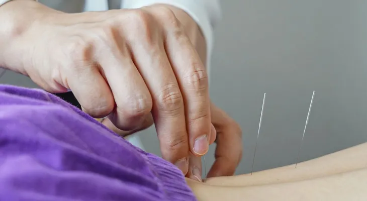 Brasil regulamenta exercício profissional da acupuntura