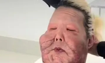 Juju do Pix passa por nova cirurgia para retirada de óleo mineral do rosto