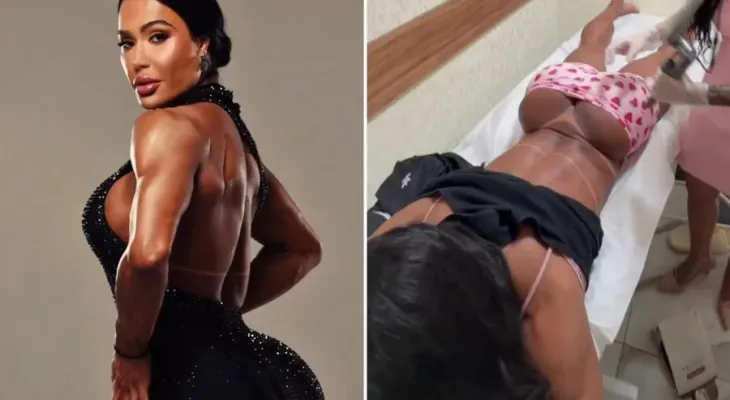 Gracyanne Barbosa remove tatuagem feita em homenagem ao cantor Belo