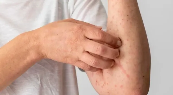 Porto Alegre confirma caso de mpox e orienta foliões para o Carnaval