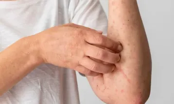 Porto Alegre confirma caso de mpox e orienta foliões para o Carnaval