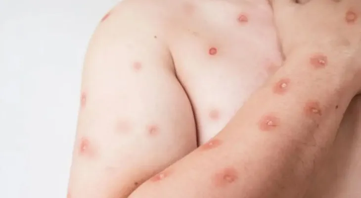 Mpox em 2026: Brasil registra 136 casos e nova variante liga alerta; veja sintomas