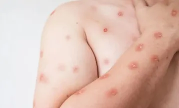 Sobe para 140 número de casos confirmados de Mpox no país, em 2026