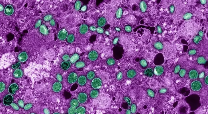 Doença Mpox: Brasil já registra 149 casos em 2026; veja estados com mais registros