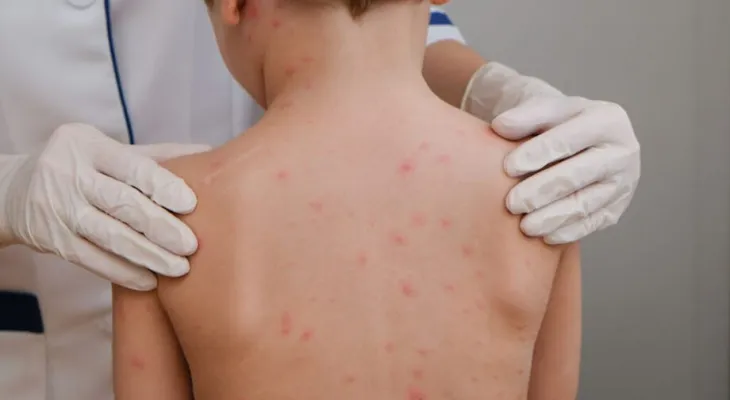 Palotina confirma três casos de meningite viral e intensifica monitoramento