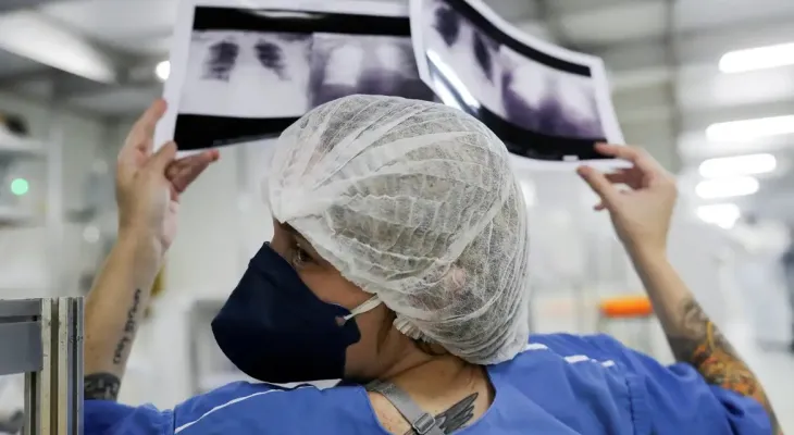 Quase 90% dos casos de câncer de pulmão no SUS são diagnosticados em estágio avançado