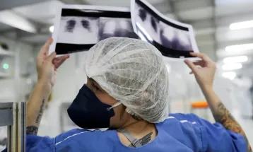 Quase 90% dos casos de câncer de pulmão no SUS são diagnosticados em estágio avançado