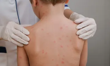 Palotina confirma três casos de meningite viral e intensifica monitoramento