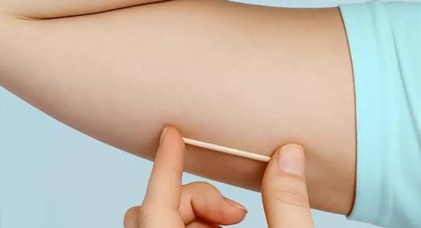 Anvisa amplia para cinco anos a duração do implante contraceptivo disponível no SUS